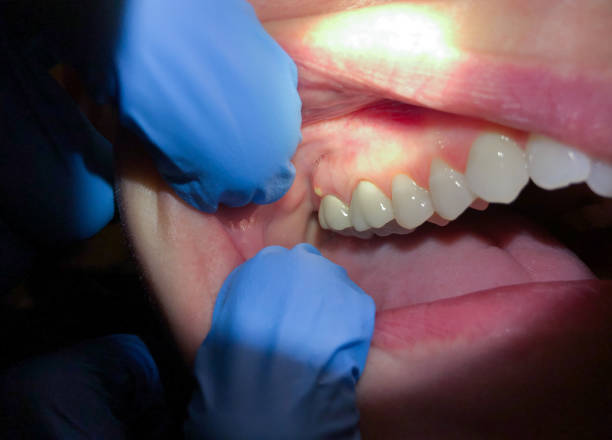 Best Lost Filling or Crown Replacement in Sartell, MN